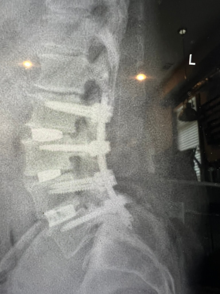 Minimally invasive spine surgery incision next to a pen for scale — approximately 1 cm access point